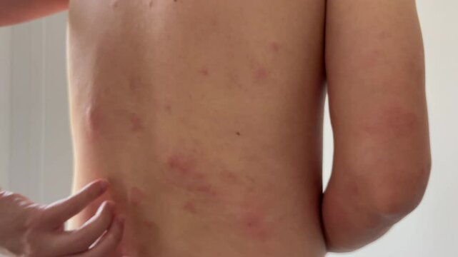 Young asian man itching and scratching on his back from allergic itchy dry skin eczema dermatitis insect bites