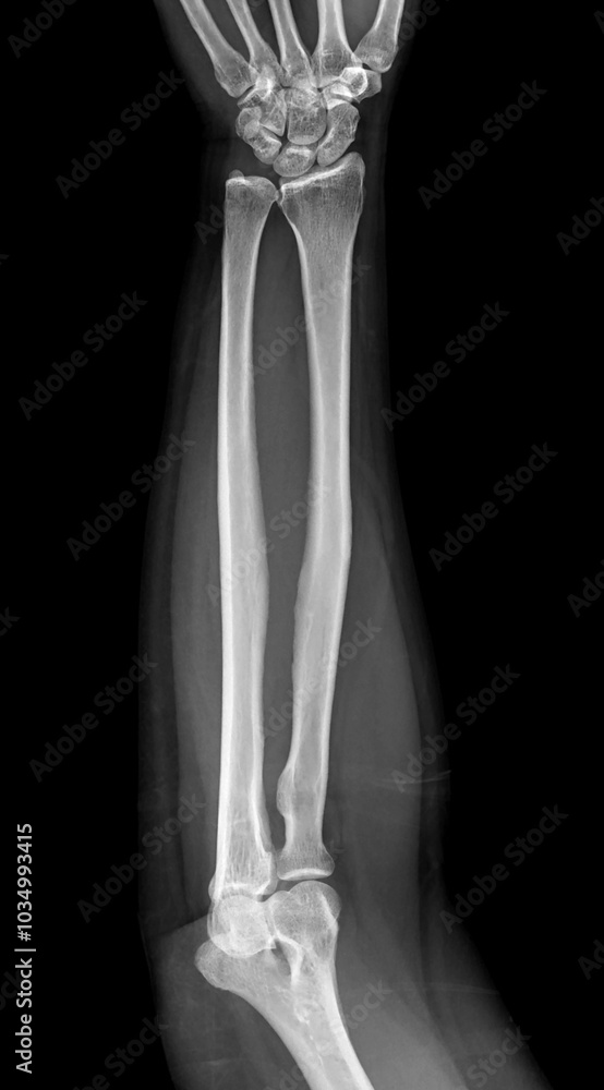 Poster x-ray image of the forearm showing the radius and ulna bones in proper alignment, with no visible fr