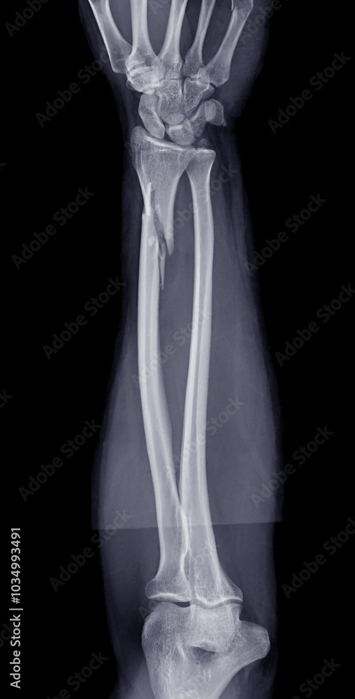 Poster x-ray of the forearm displaying a radius bone fracture, critical for evaluating the extent of the in