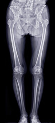 Scanogram image displaying the pelvis, femur, and tibia in alignment, commonly used for assessing...