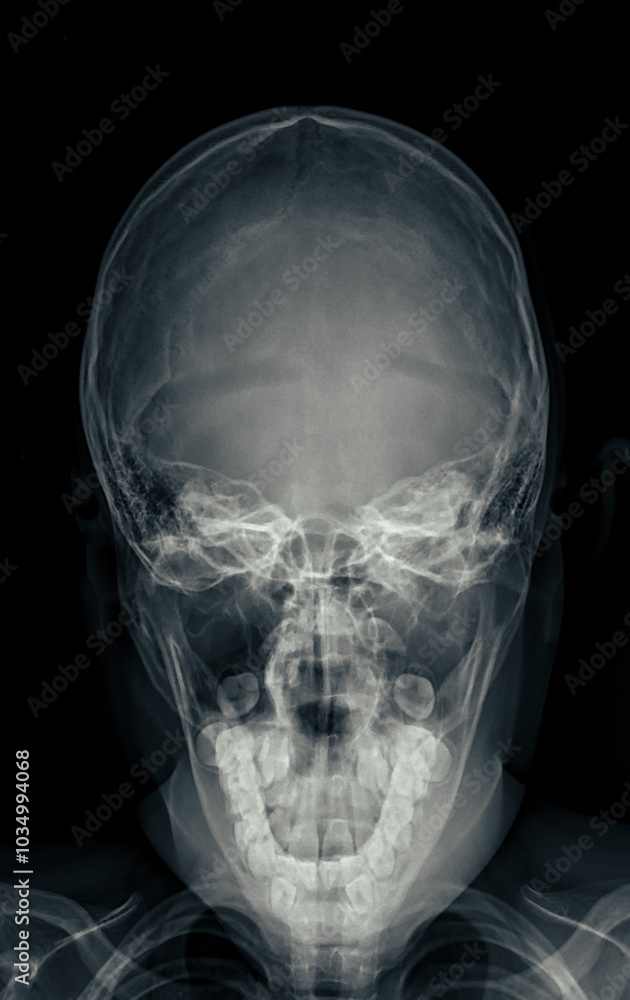 Poster x-ray image of the skull in town's view, displaying clear bone structure with no visible abnormaliti