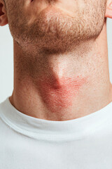 Naklejka premium Close-up of neck with red marks, isolated