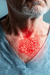 Fototapeta premium Skin irritation visible on male's neck.