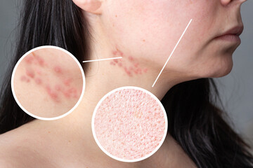 Woman with inflamed acne on her neck and jawline area. Problem skin treatment concept. Cosmetology...
