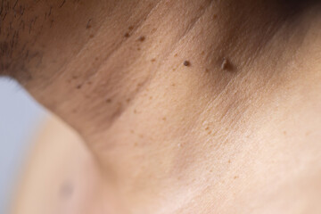 Skin tags or soft tissue tumors that are a skin problem on the neck