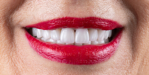 dental crowns and veneers