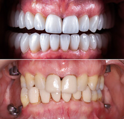 dental crowns and veneers