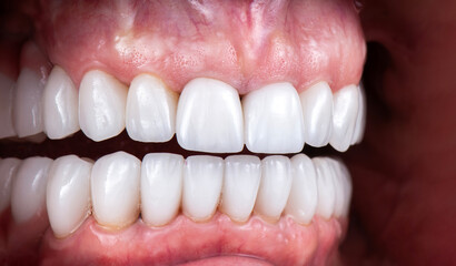 dental crowns and veneers