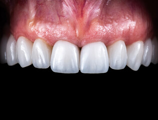 Obraz premium dental crowns and veneers