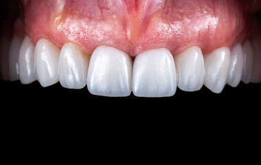 Obraz premium dental crowns and veneers