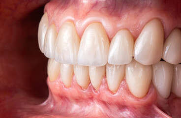 dental crowns and veneers