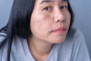 Enlarged circles indicate facial skin problems such as blemishes, freckles, uneven skin tone and large pores on combination skin. Dull and rough skin. The concept of good health
