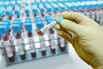 Blood Sample Collection in a Test Tube for Medical Testing and Research - Hepatitis C - Laboratory...