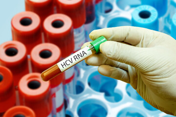 Blood Sample Collection in a Test Tube for Medical Testing and Research - HCV RNA Test - Laboratory...