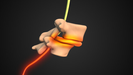 Vertebral Slippage Resulting in Spondylolisthesis Symptoms