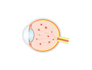 Diabetic retinopathy. Healthy eye and damaged eye. Retinal damage, vision loss. Diabetes disease. Hemorrhages, aneurysms, abnormal blood vessels. Scientific vector illustration.