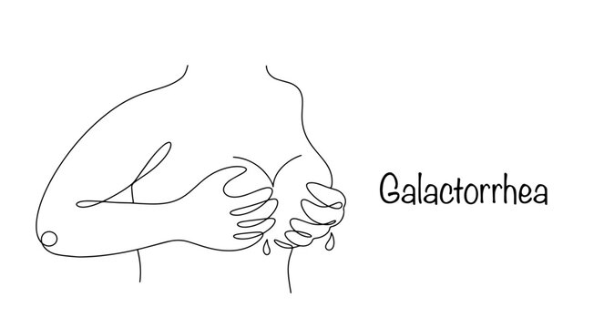Galactorrhea Images – Browse 56 Stock Photos, Vectors, and Video ...