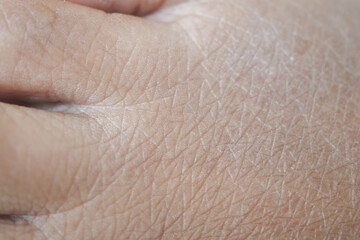 Closeup view of dry human skin .