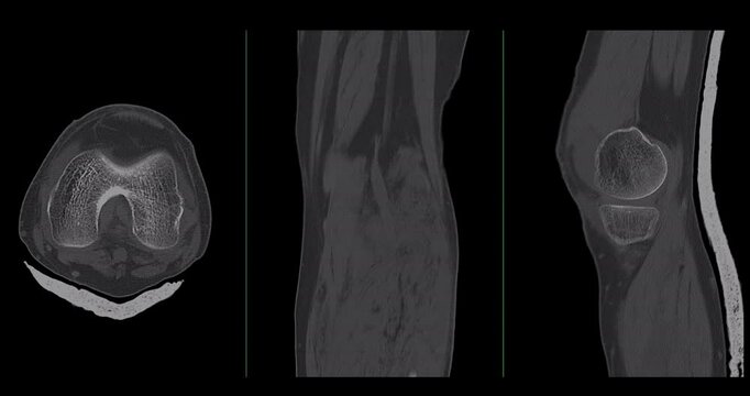 Knee Joint CT-Scan Revealing Tibial Fracture:The scan highlights a distinct fracture in the tibia, located beneath the knee joint. The break is visible as a crack.