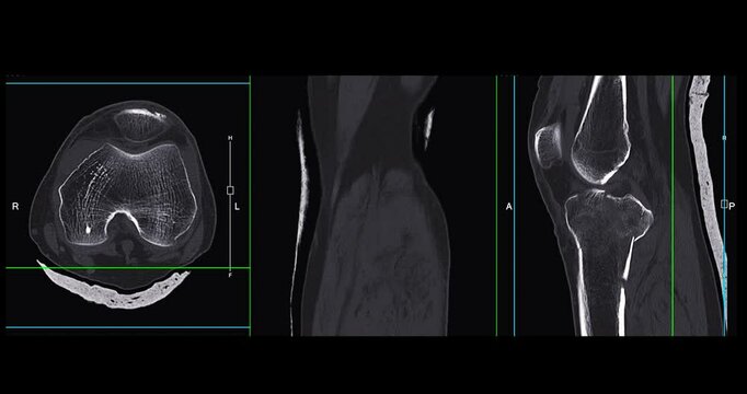 Knee Joint CT-Scan Revealing Tibial Fracture:The scan highlights a distinct fracture in the tibia, located beneath the knee joint. The break is visible as a crack.