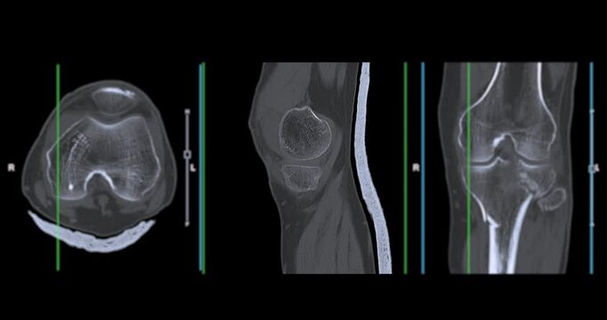 Knee Joint CT-Scan Revealing Tibial Fracture:The scan highlights a distinct fracture in the tibia, located beneath the knee joint. The break is visible as a crack.