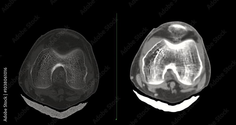 Poster knee joint ct-scan revealing tibial fracture:the scan highlights a distinct fracture in the tibia, l