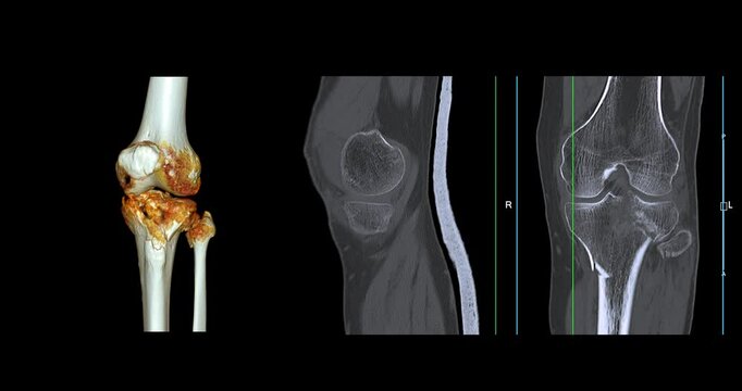 Knee Joint CT-Scan Revealing Tibial Fracture:The scan highlights a distinct fracture in the tibia, located beneath the knee joint. The break is visible as a crack.
