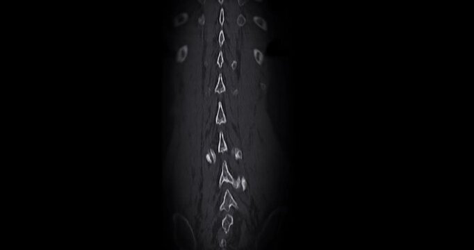 CT Scan L-S pine Showing T12 Compression Injury, where the front part of the bone has collapsed slightly. The fracture looks stable, and there is no damage to the spinal cord or nearby tissues.