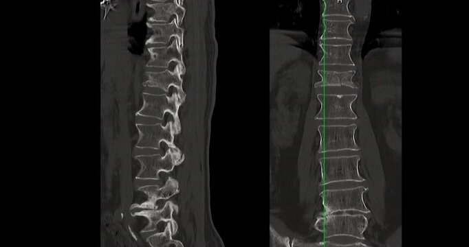 CT Scan L-S pine Showing T12 Compression Injury, where the front part of the bone has collapsed slightly. The fracture looks stable, and there is no damage to the spinal cord or nearby tissues.