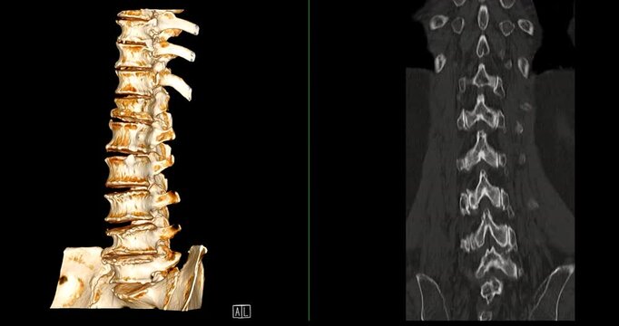 CT Scan L-S pine Showing T12 Compression Injury, where the front part of the bone has collapsed slightly. The fracture looks stable, and there is no damage to the spinal cord or nearby tissues.