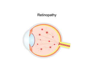 Diabetic retinopathy. Healthy eye and damaged eye. Retinal damage, vision loss. Diabetes disease. Hemorrhages, aneurysms, abnormal blood vessels. Scientific vector illustration.
