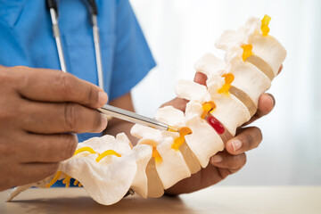 Doctor with lumbar vertebra bone skeleton and nerve model for treatment in the orthopedic department.