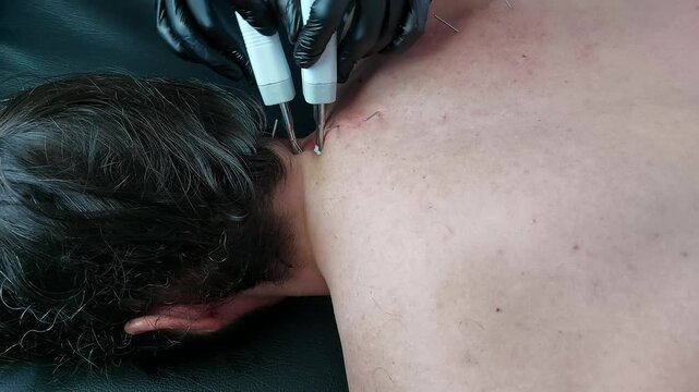 Dry needling with electrical stimulation or electro dry needling therapy using an acupuncture pen point stimulator during a physiotherapy session
