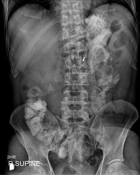 Abdominal radiograph showing a barium examination of the bowel after 2 hours