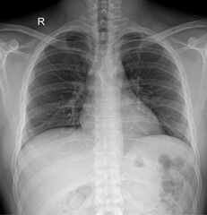 Chest X-ray for Lung and Heart Health Assessment in Diagnostic Imaging