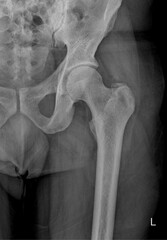 Radiographic Imaging of Hip Joint for Fracture Detection and Injury Evaluation