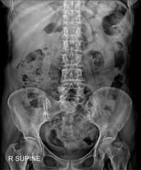 Abdomen Supine X-Ray for Abdominal Examination