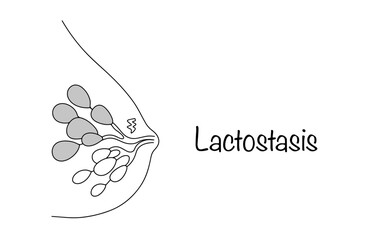 Lactostasis