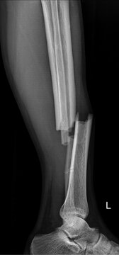 Emergency x-Ray showing tibia and fibula fracture lateral radiograph 