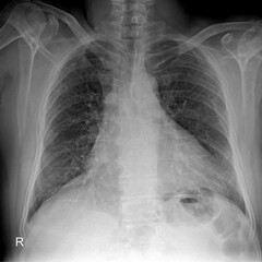 Chest X-ray for Comprehensive Lung and Heart Health Evaluation