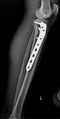 X-ray of Tibial Plateau Fracture After Surgical Repair