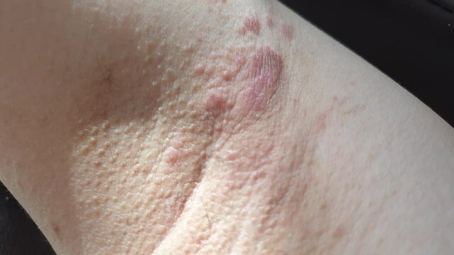 ringworm eczema infected on human body red rash ring on skin close up shot