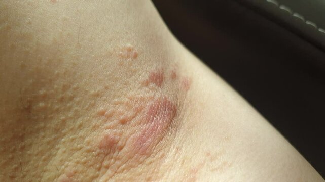 ringworm eczema infected on human body red rash ring on skin close up