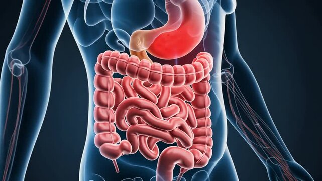 A detailed diagram of the human digestive system showing the effects of Crohn's disease. Perfect for medical publications and educational materials.