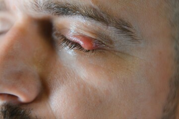 mabait, barley on the eye Caucasian men