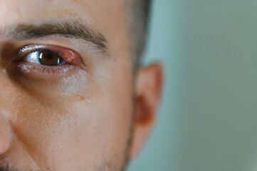mabait, barley on the eye Caucasian men