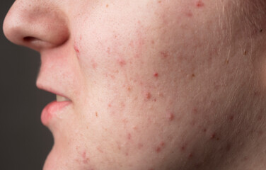 Acne. Problem skin skincare. Pimples, acne, pores, scars. Natural skin. Skin care treatment....