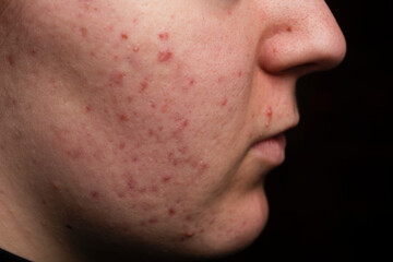 Skin treatment. Acne vulgaris, black spots and pimples. Girl with bad skin. Skin acne background....