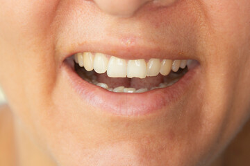 Close up of chipped tooth because of a bike accident