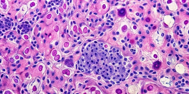 Medical stock photo of bird's eye view bone marrow core biopsy pathology showing disseminated Histoplasma infection